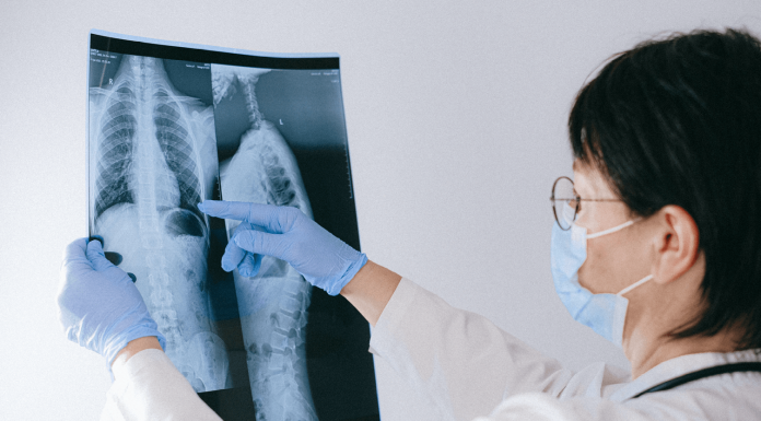 Le deep learning pourrait permettre de détecter la tuberculose plus précocement dans les pays à faibles revenus